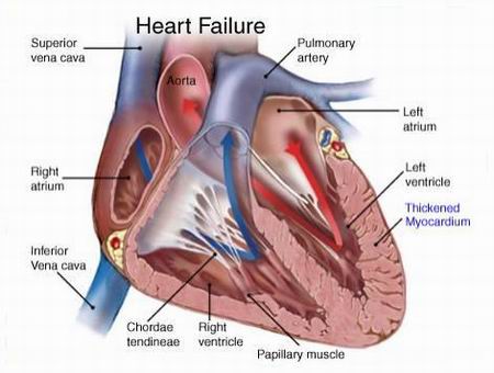 cardiaca congestizia.jpg