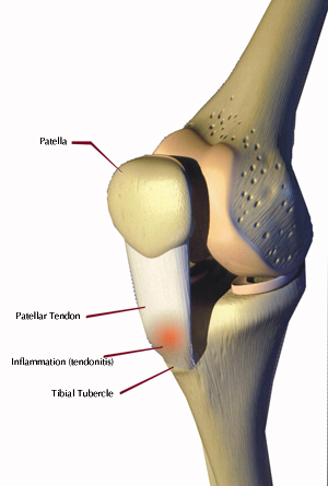 osgood-schlatters esempio di come agisce la malattia.jpg