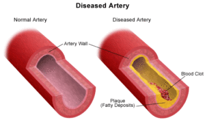 arterie-300x175.gif