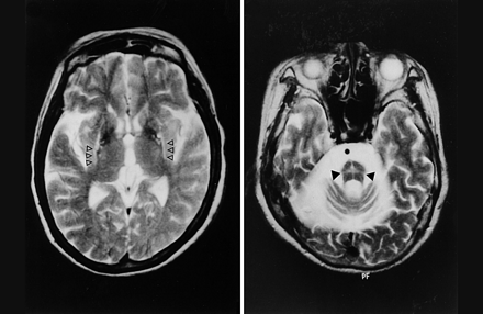 Atrofia multisistemica (MSA).gif