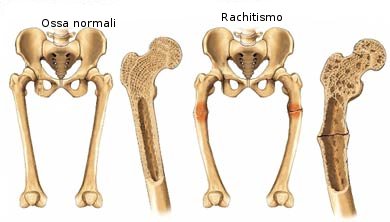 Osteomalacia1.jpg