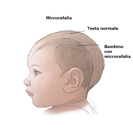 esempio della microcefalia.jpg