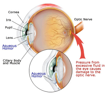 glaucoma malattie.gif