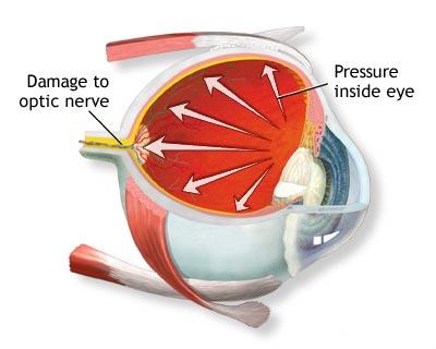 glaucoma.jpg