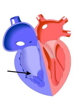 Anomalia di Ebstein : sintomi, cause e cure