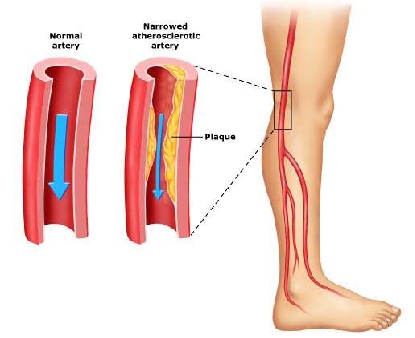 Arteriopatia periferica 1.jpg