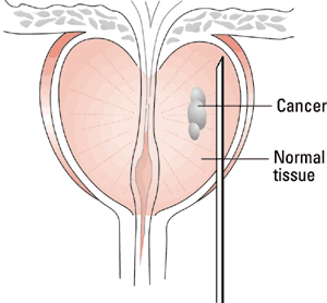 Biopsia della prostata.gif