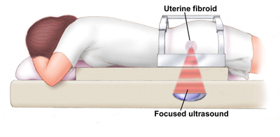 Chirurgia a ultrasuoni focalizzati per i fibromi uterini.jpg
