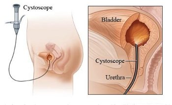 Cistoscopia.jpg