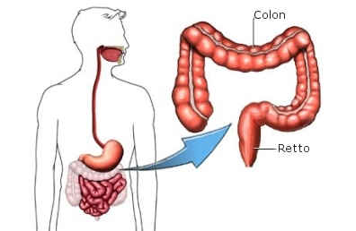 Colectomia.jpg