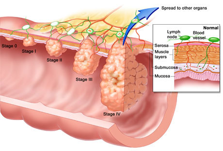 Colon Cancer Image.jpg