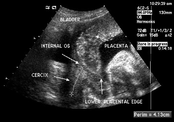 Placenta previa : cause, complicazioni e cure