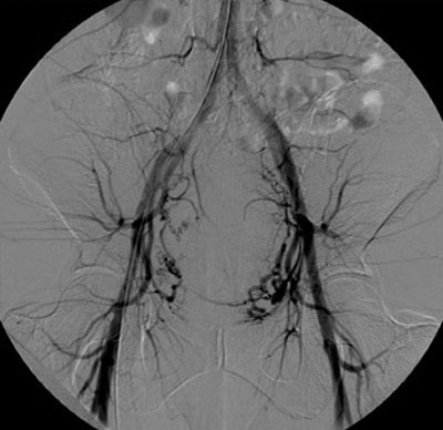 Embolizzazione dell'arteria uterina : procedura, rischi e benefici