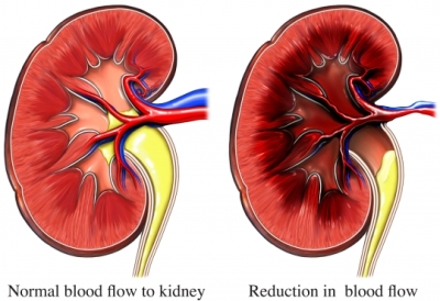 Granulomatosi effetti sui reni21.jpg