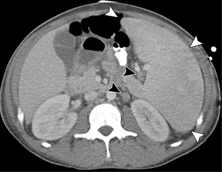 HHV-8 IMMAGINE RADIOGRAFICA.jpg