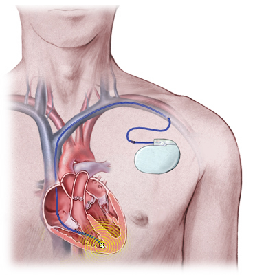 ICD disegno impianto del defibrillatore.jpg