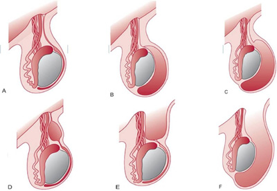 Idrocele01.jpg