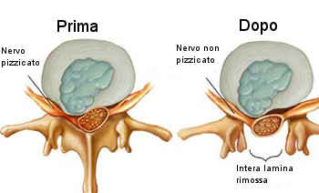 Laminectomia_esempio.jpg