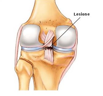 Lesione del legamento crociato posteriore : cause e cure