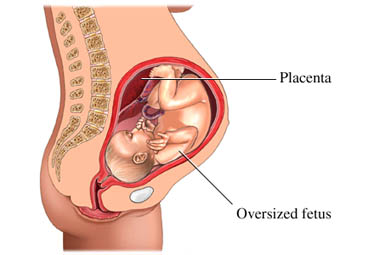 Macrosomia fetale.jpg