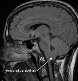 Malformazione di Arnold-Chiari