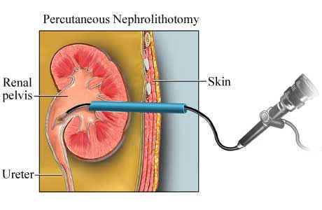 Nefrolitotomia percutanea.jpg