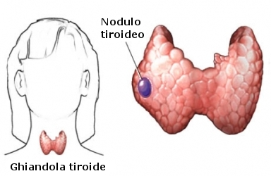 Noduli della tiroide_immagine.png