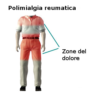 Polimialgia reumatica.jpg