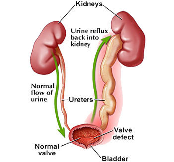 Reflusso vescico-ureterale1.jpg