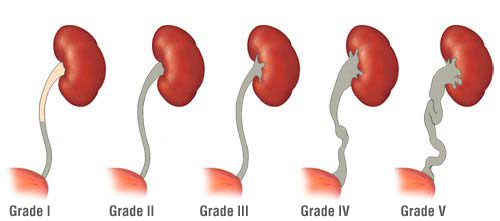 Reflusso vescico-ureterale21.jpg