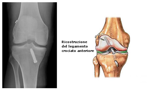 Ricostruzione del legamento crociato anteriore : guarigione e chirurgia
