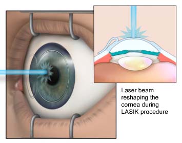 Chirurgia refrattiva LASIK : procedura, rischi e prognosi