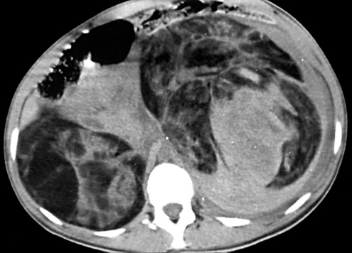 Sclerosi tuberosa : sitomi, cause, diagnosi e cure