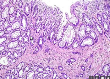 Sindrome dell'ulcera solitaria del retto : cause e cure