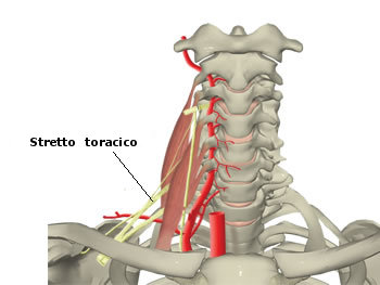 Sindrome dello stretto toracico.jpg