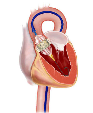 Sostituzione della valvola aortica transcatetere