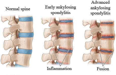 Spondilite anchilosante.jpg