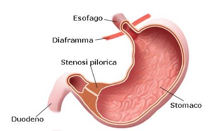 Stenosi pilorica.jpg