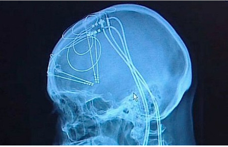 Stimolazione cerebrale profonda