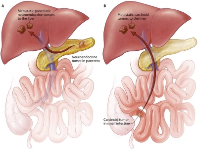 Tumori carcinoidi : sintomi, cause, complicazioni, diagnosi e cure