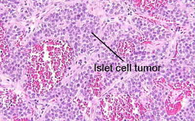 Tumore delle cellule insulari del pancreas : sintomi, cause e terapie