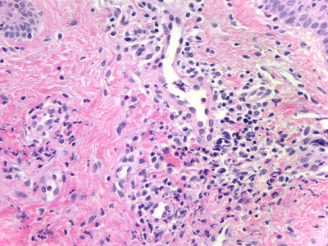 Granulomatosi di Wegener
