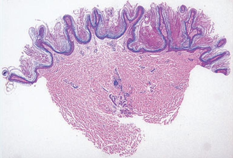 Acanthosis nigricans : sintomi, segni, cause e cure