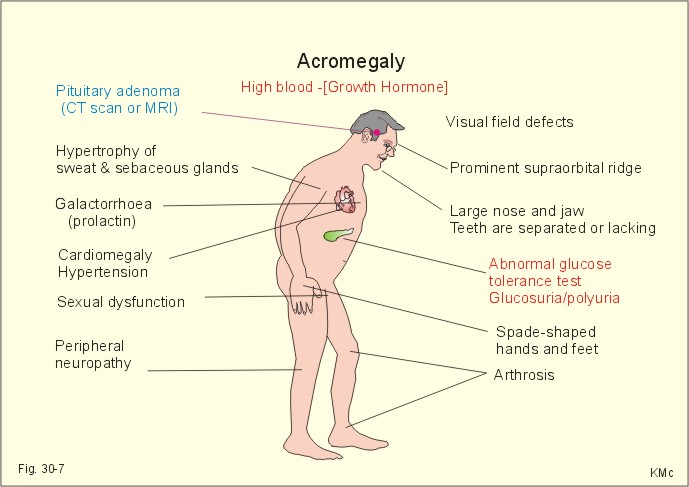 acromegalia 21.jpg