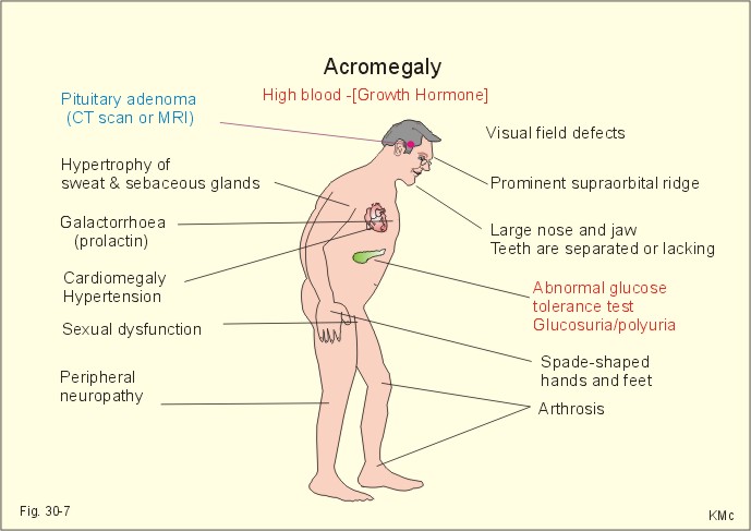 acromegalia 21.jpg