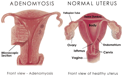 adenomiosi1.gif