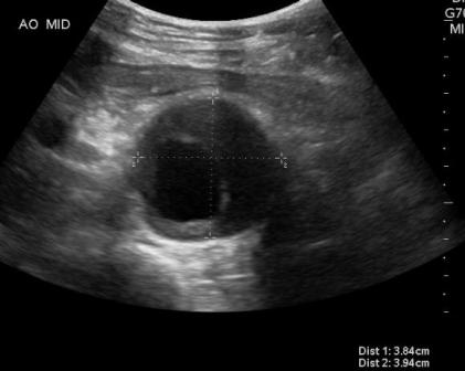 aneurisma aorta addominale.JPG