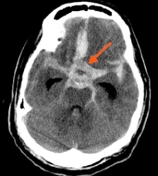 aneurisma cerebrale.jpg