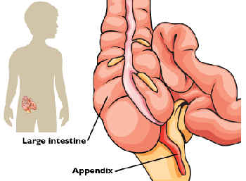 Appendicite: sintomi e chirurgia