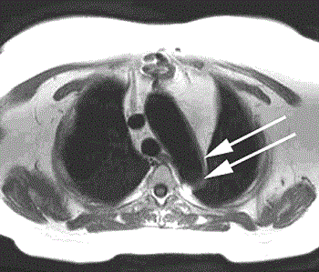 arterite di takayasu.gif